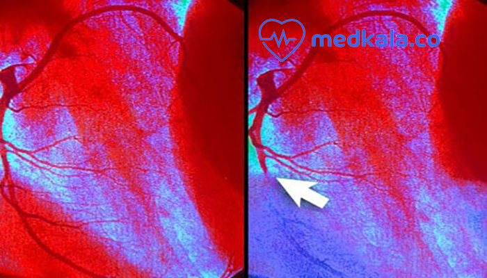  آنژیوگرافی چیست پیشگیری ازبیماری قلبی04