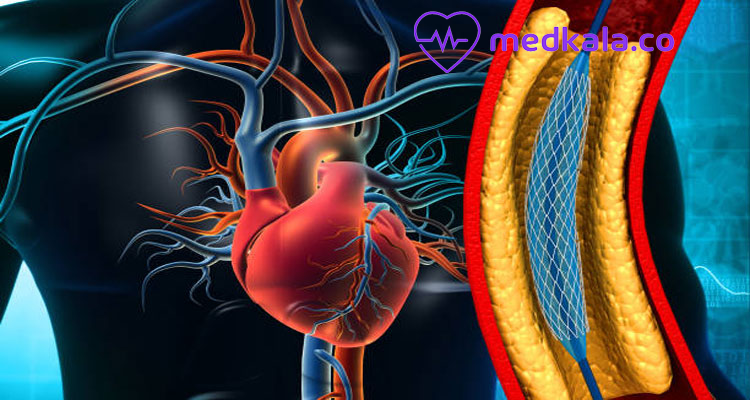  آنژیوگرافی چیست پیشگیری ازبیماری قلبی