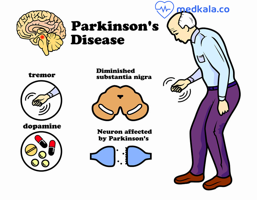 علائم بیماری پارکینسون+ درمان 